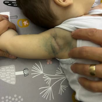 ebebek Boyası Bebeğin Tenine Çıkan Kazak