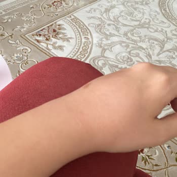 Batman Yaşam Hastanesi Acil Servisindeki Serum Yanığı