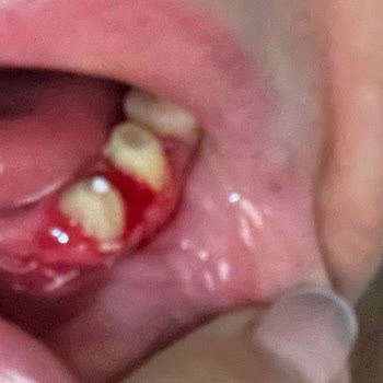 DF Dental Batman Df Diş Tedavi Süreci