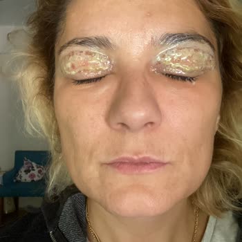 Nama Clinic (Kalamış) Göz Kapağı Kaldırma İşlemi