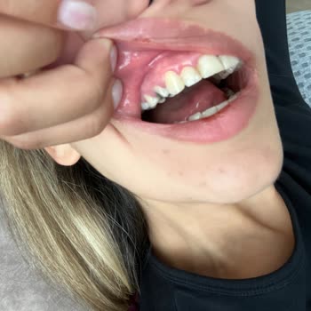 Sultanbeyli Ağız Ve Diş Sağlığı Eğitim Araştırma Hastanesi Doktorun Beceriksizliği Sağlam Dişim Kırıldı