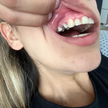 Sultanbeyli Ağız Ve Diş Sağlığı Eğitim Araştırma Hastanesi Doktorun Beceriksizliği Sağlam Dişim Kırıldı