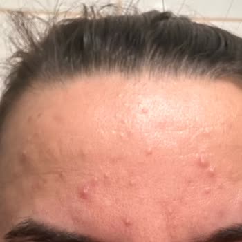 Kiperin Collagen Kiperin Kolajen Sivilce Yaptı