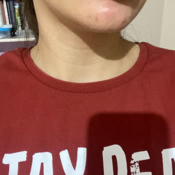 Watsons Celenes Makyaj Temizleme Suyu Sivilce Alerji Yaptı