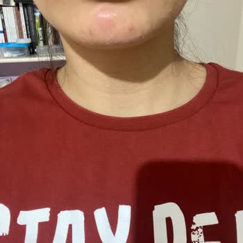 Watsons Celenes Makyaj Temizleme Suyu Sivilce Alerji Yaptı