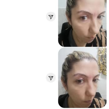 Vanity Estetik Başarısız Ameliyat