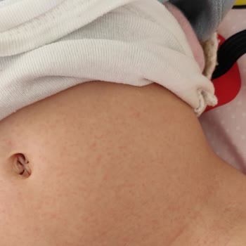 Humanis Sağlık İburamin Cold Alerji Yaptı