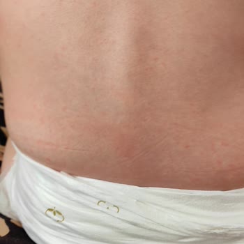 Humanis Sağlık İburamin Cold Alerji Yaptı