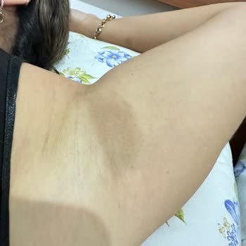 Özel Konak Hastanesi Lazer Yanığı (İhmal)