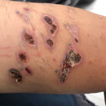Medica Derma Dövme Silme Esnasında Kolum 3. Derece Yandı