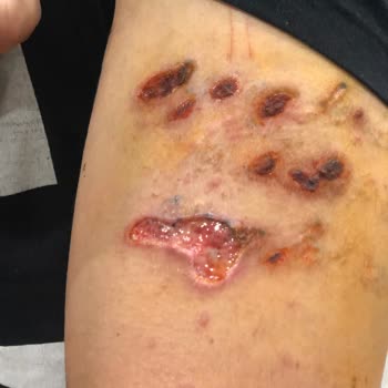 Medica Derma Dövme Silme Esnasında Kolum 3. Derece Yandı
