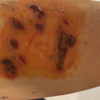 Medica Derma Dövme Silme Esnasında Kolum 3. Derece Yandı