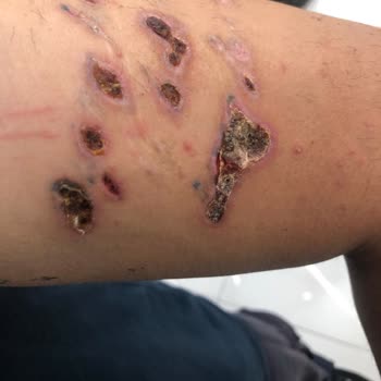 Medica Derma Dövme Silme Esnasında Kolum 3. Derece Yandı