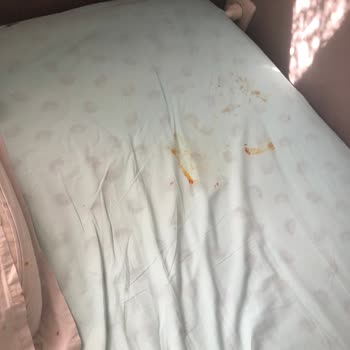 Medica Derma Dövme Silme Esnasında Kolum 3. Derece Yandı