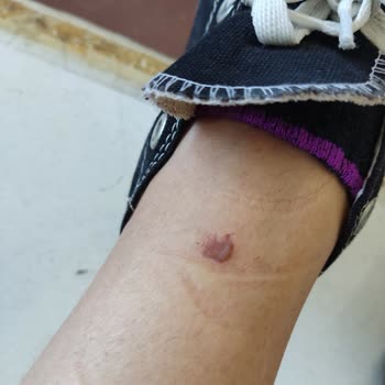 Este Keyff Güzellik Lazer Yanığı Oluştu