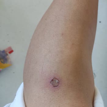 Este Keyff Güzellik Lazer Yanığı Oluştu