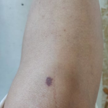 Este Keyff Güzellik Lazer Yanığı Oluştu