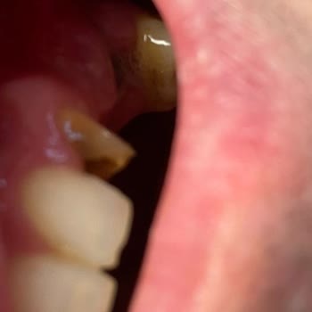 İstanbul Sultangazi Ağız ve Diş Sağlığı Merkezi Dişimi Düzgün Çekmedi