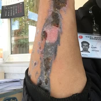 Dövme Sildirme Adenvip Çorum