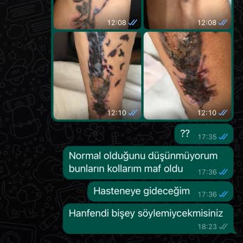 Dövme Sildirme Adenvip Çorum