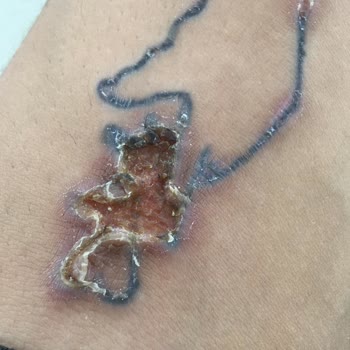 Dövme Sildirme Adenvip Çorum