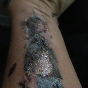 Dövme Sildirme Adenvip Çorum