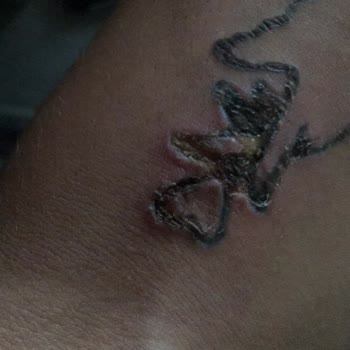 Dövme Sildirme Adenvip Çorum