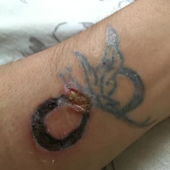 Dövme Sildirme Adenvip Çorum