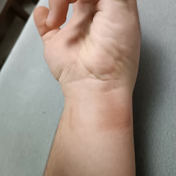 Oppo Marka Watch Free Bileğimde Yara Yapıyor