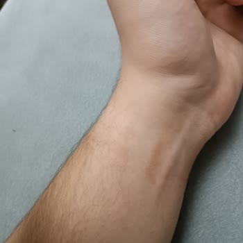 Oppo Marka Watch Free Bileğimde Yara Yapıyor