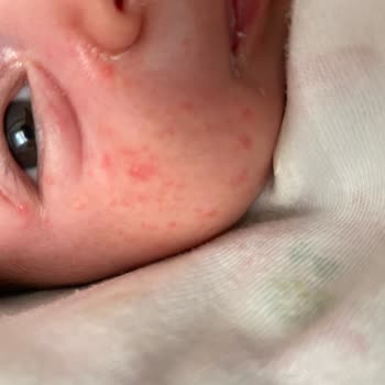 Mustela Alerji Yaptı İçerik Temiz Değil