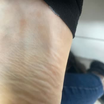 Puma Rsx Ayak Alerjisi