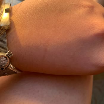 Suit Güzellik Merkezleri Suit Lazer Etkisizliği