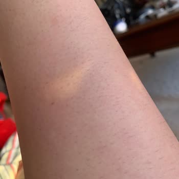 Suit Güzellik Merkezleri Suit Lazer Etkisizliği