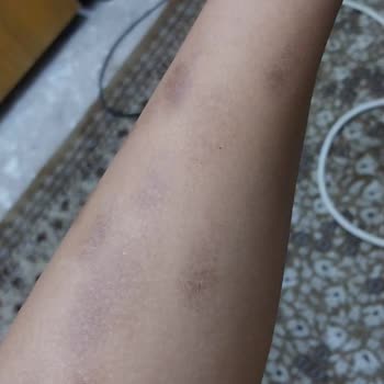 M.K İlaç Kozmetik Güzellik Salonu Lazer Kollarımı Yaktı