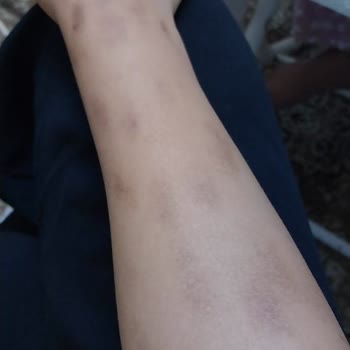 M.K İlaç Kozmetik Güzellik Salonu Lazer Kollarımı Yaktı