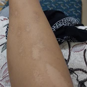 M.K İlaç Kozmetik Güzellik Salonu Lazer Kollarımı Yaktı