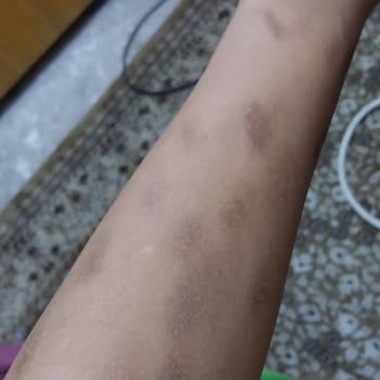 M.K İlaç Kozmetik Güzellik Salonu Lazer Kollarımı Yaktı