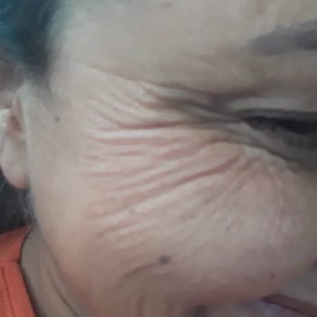 Dr. Hakan Yasaer Medikal Estetik Botoks Gençlik Aşısı Memnuniyetsizliği!