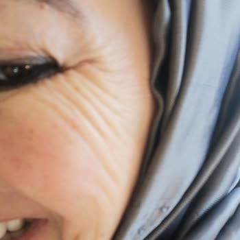 Dr. Hakan Yasaer Medikal Estetik Botoks Gençlik Aşısı Memnuniyetsizliği!