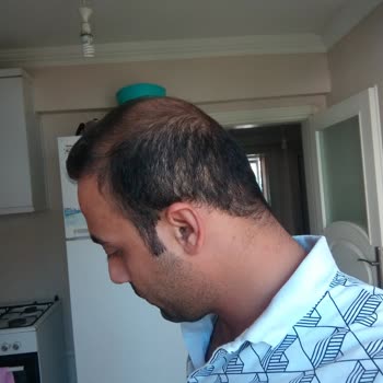 Sante Plus Hastanesi Yanlış Saç Ekimi