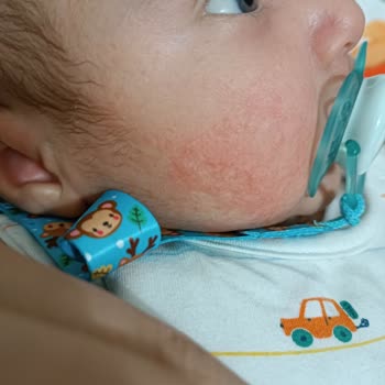 Mustela Köpük Şampuan Alerji Yaptı