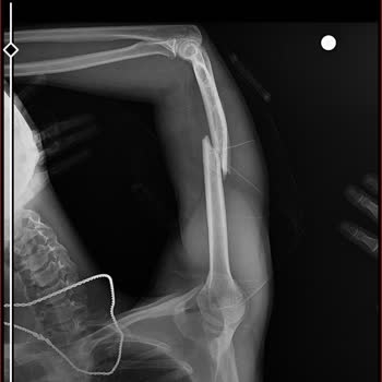 Kredi ve Yurtlar Kurumu Bazadan Düştü Kol Kırık