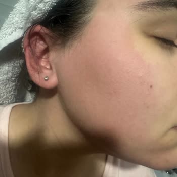 Sebamed Saç Dökülme Karşıtı Şampuanın Yüzümü Güneş Yanığı Gibi Yakması