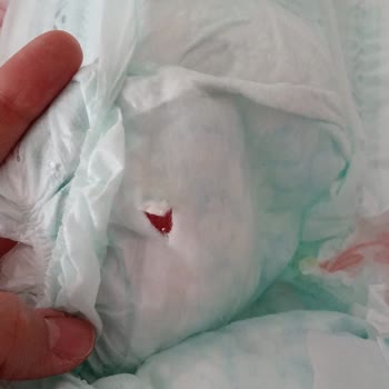 Prima Sızdırma Ve Bezin Delik Çıkması