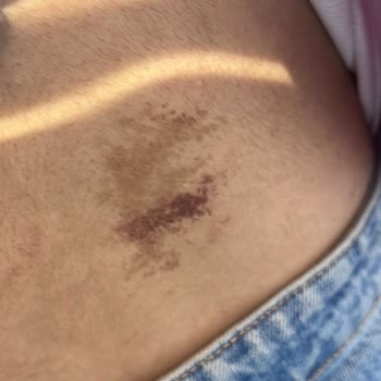 Bionep Güzellik Merkezi İlk Seansımda Lazerde Tüm Vücudum Yandı