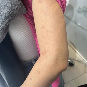 Bionep Güzellik Merkezi İlk Seansımda Lazerde Tüm Vücudum Yandı