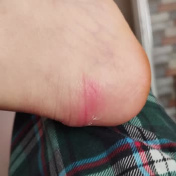 Greyder Botun Ayağımı Vurması