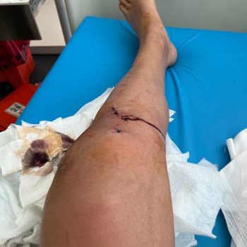 KizlarSoruyor Ön Çapraz Bağ Ameliyat