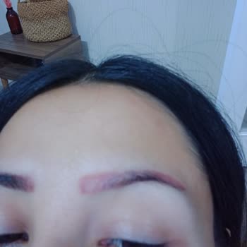 Batman Dilan Polat,2. Dereceden Yanık